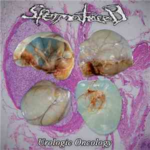 Spermatocele - Urologic Oncology flac album